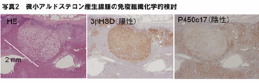 写真2 微小アルドステロン産生腺腫の免疫組織化学的検討
